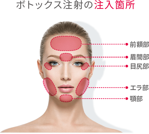 ボトックス注射の注入箇所